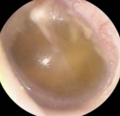 Tympanic membrane with middle-ear effusion