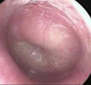 Infected tympanic membrane (acute otitis media)