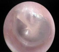 Normal tympanic membrane
