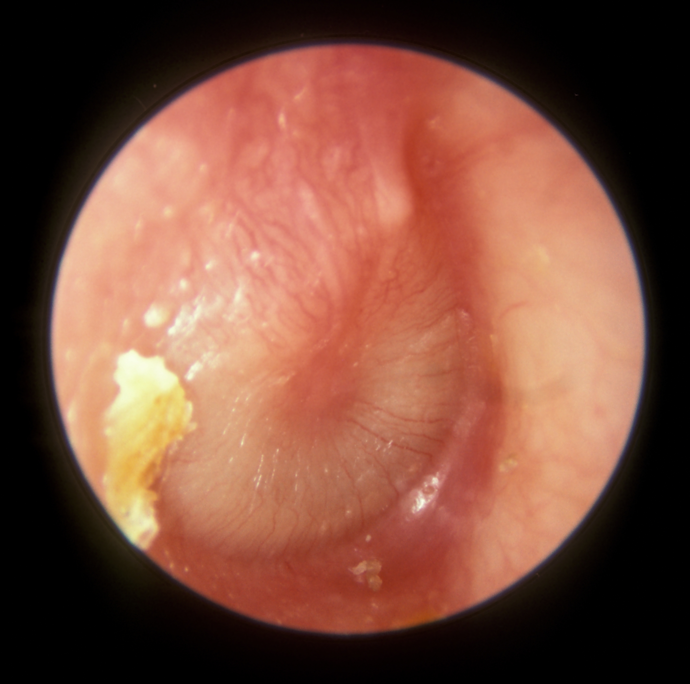 Tympanic membrane with acute otitis media