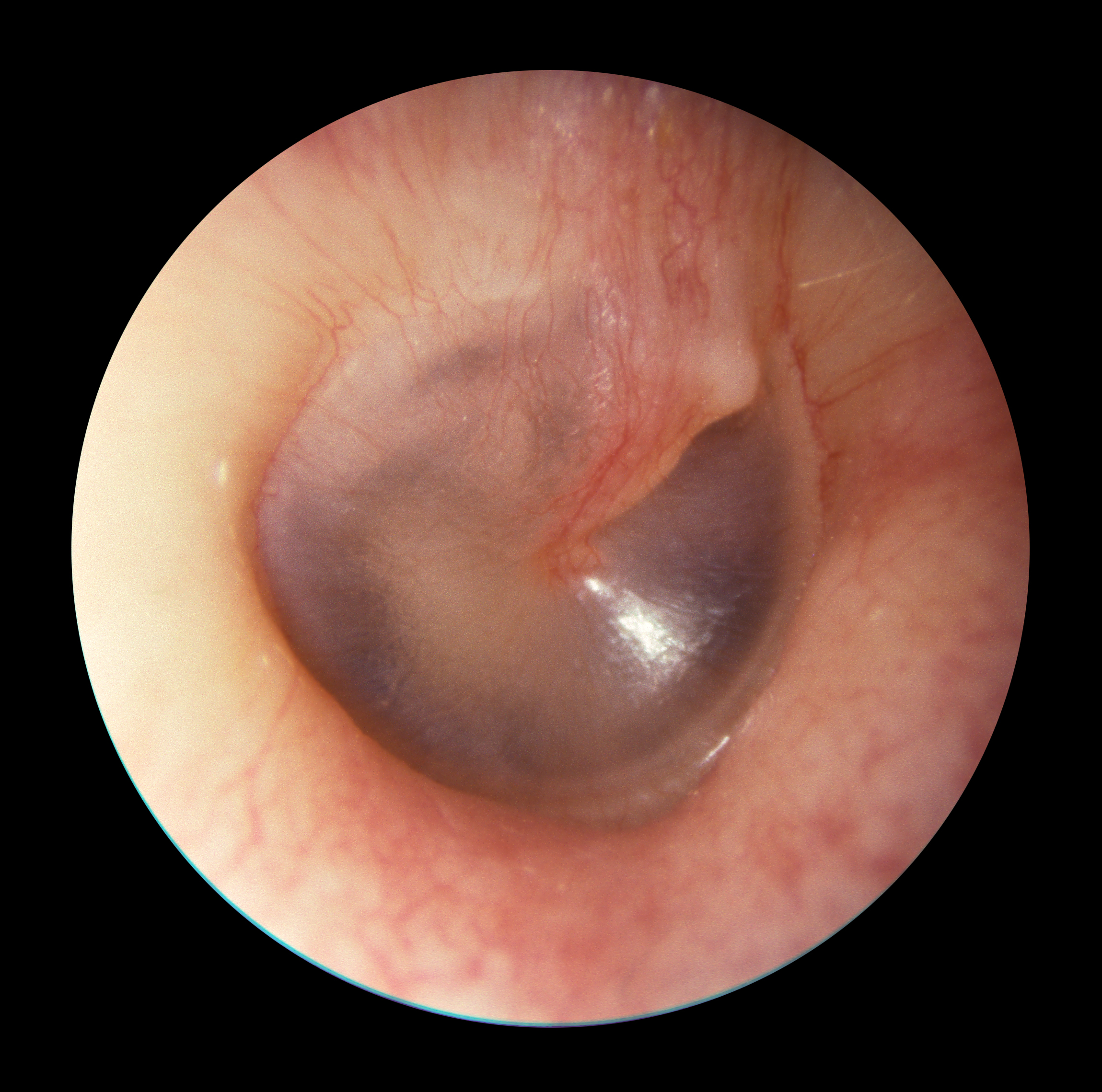 Normal tympanic membrane
